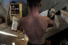 (Photos) Indonésie : Un jeune garçon avec une ’’peau écailleuse’’